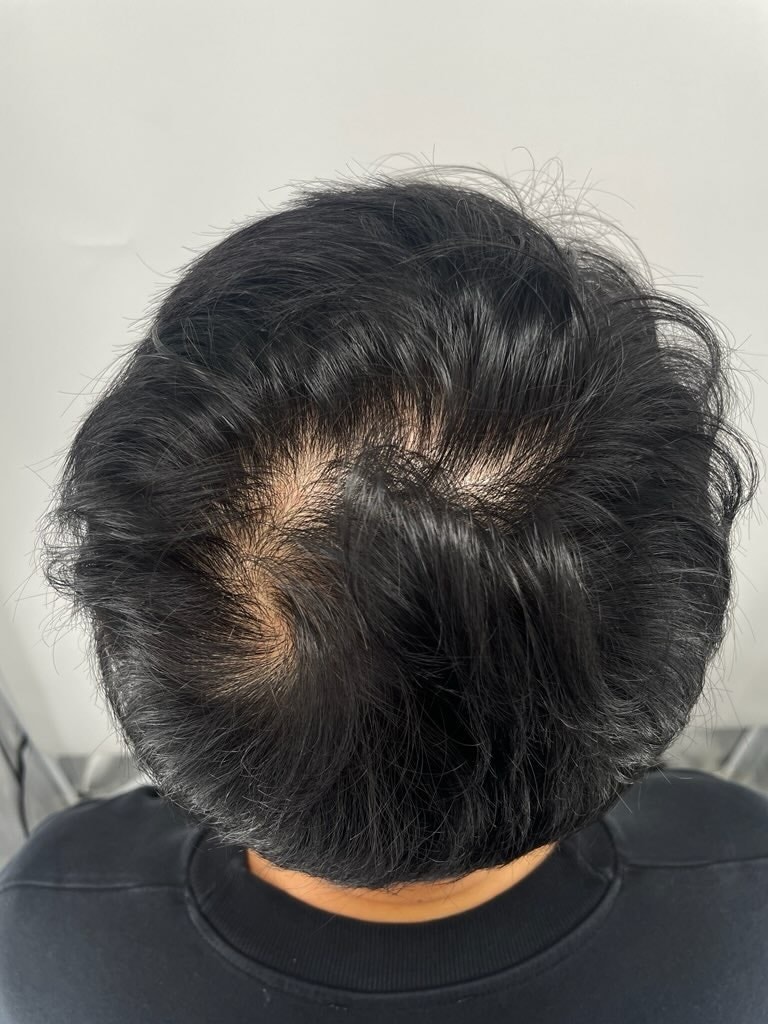 정수리 두피문신 해외에서 강남 탈모병원까지 찾은 이유^^ 뉴헤어성형외과