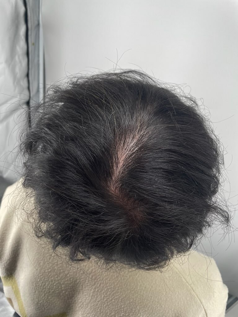 정수리 커버 문신, 강남두피문신병원 뉴헤어성형외과 추천하는 이유