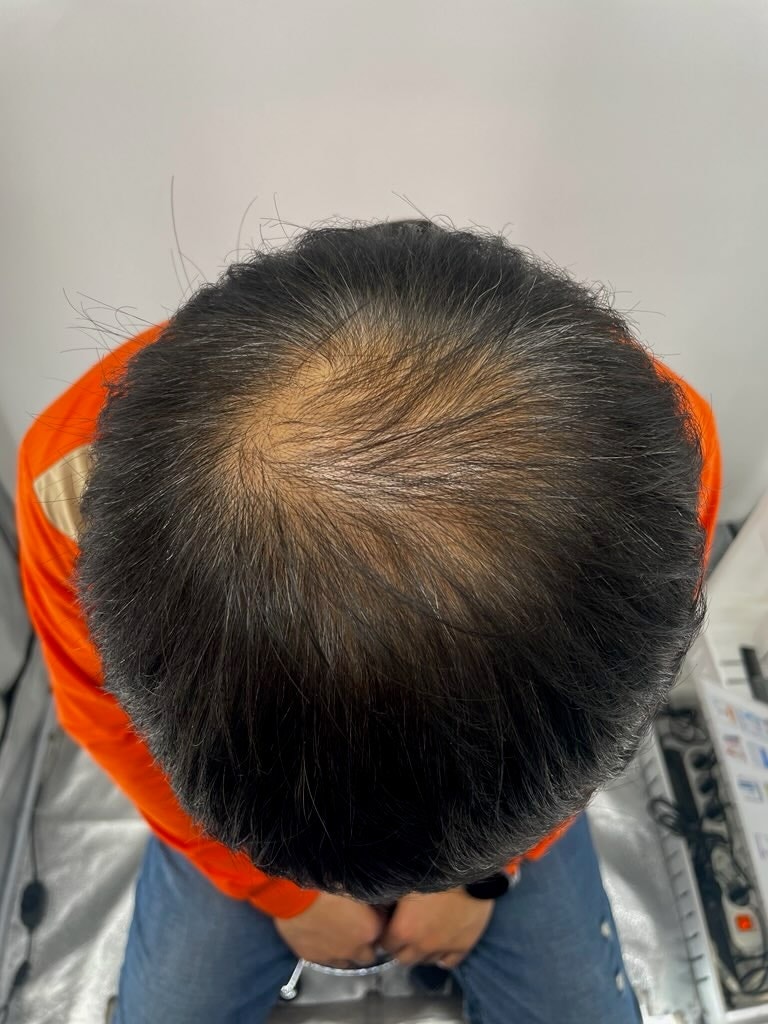 역시 강남 두피문신 병원 뉴헤어~ 너무 감사합니다! 정수리 아주 이쁘게 잘 나와서 만족도가 높아요