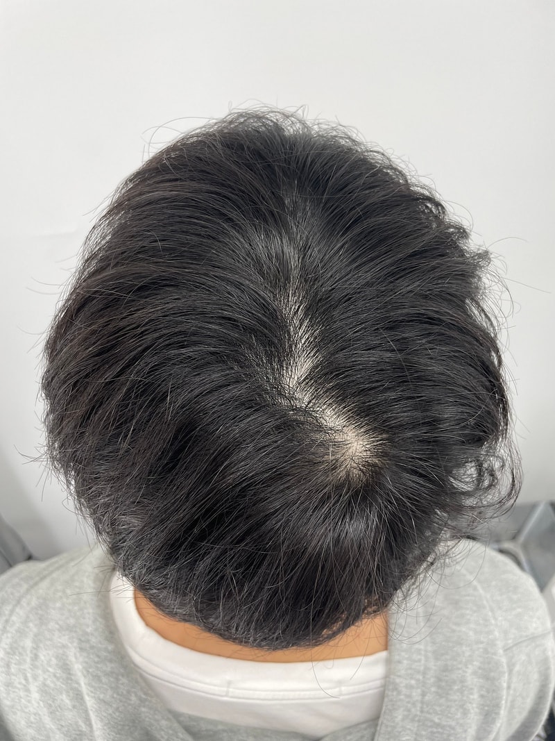 NEWHAiR 植发中心江南店头皮纹身后记！ 头顶压力用3周时间解决了