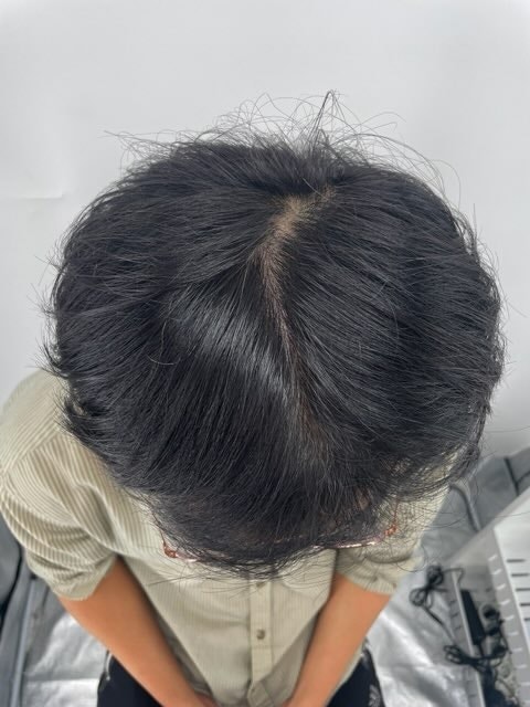 留下江南新发头皮纹身（头顶纹身）后记。^^效果好