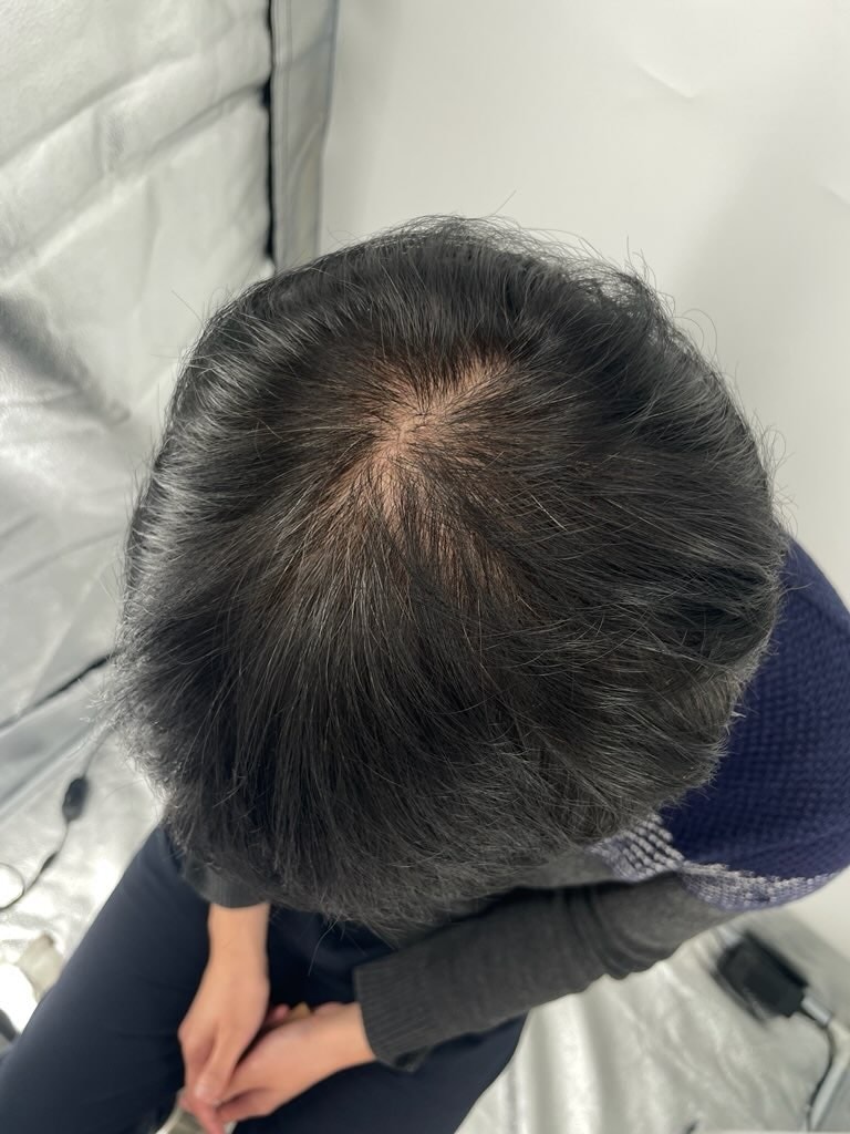 두피문신 고민이신 분들 추천합니다!! 강남뉴헤어 찐후기