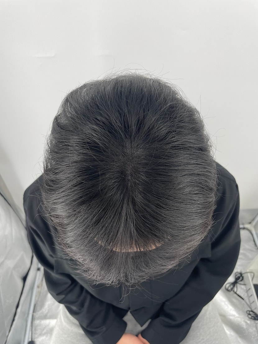 가르마 문신 후