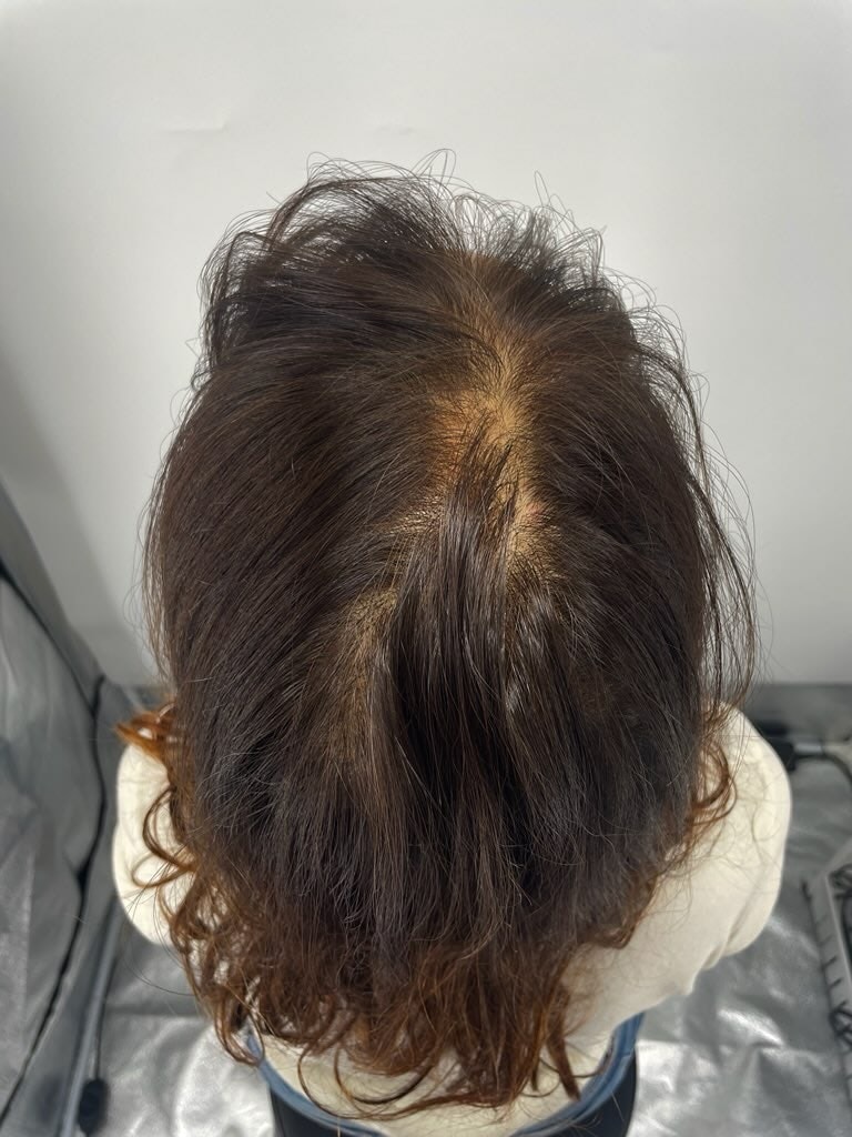 在头顶纹身头皮纹身NEWHAiR 植发中心收到的后期江南毛发移植中心中做得最好！