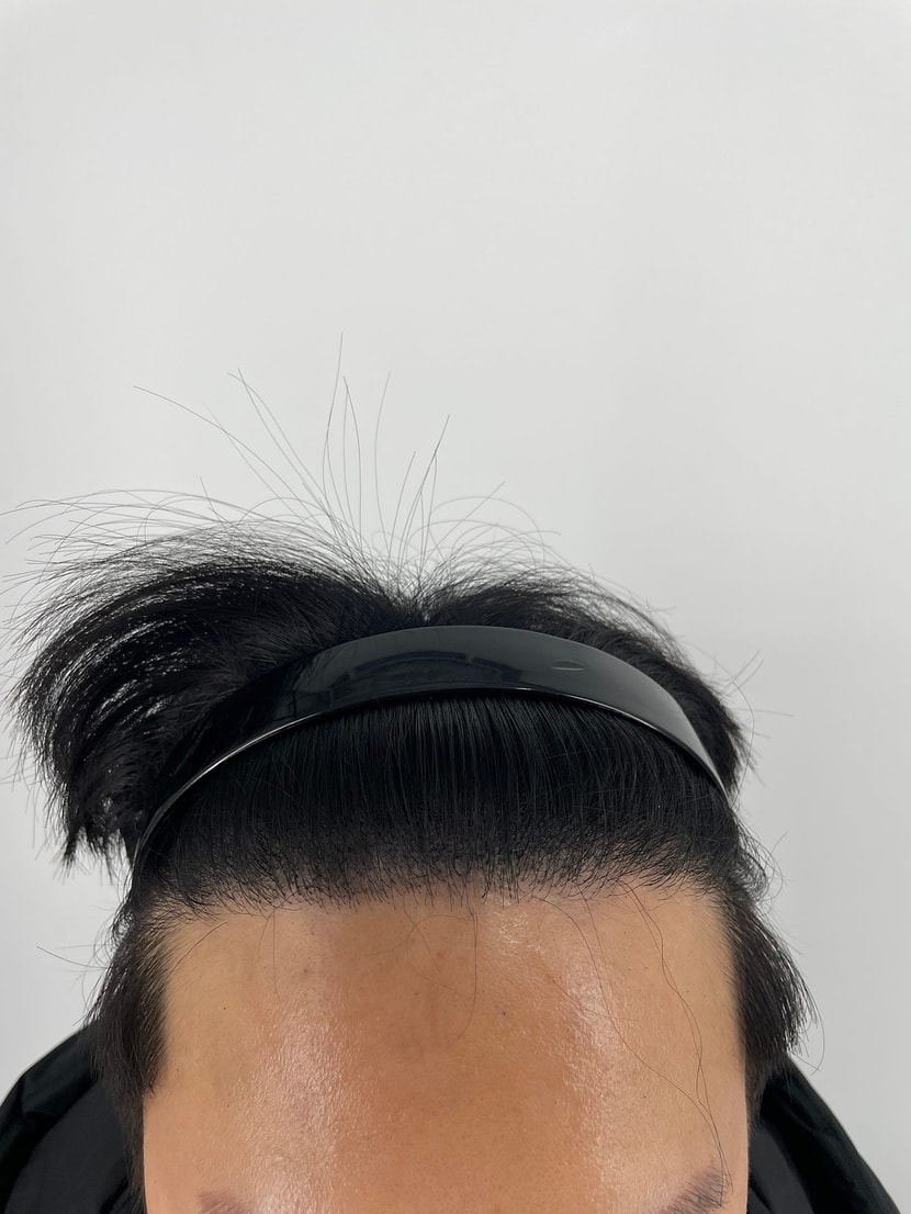 헤어라인 문신 후
