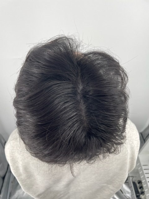 강남뉴헤어 두피문신 대단히 만족합니다~!!