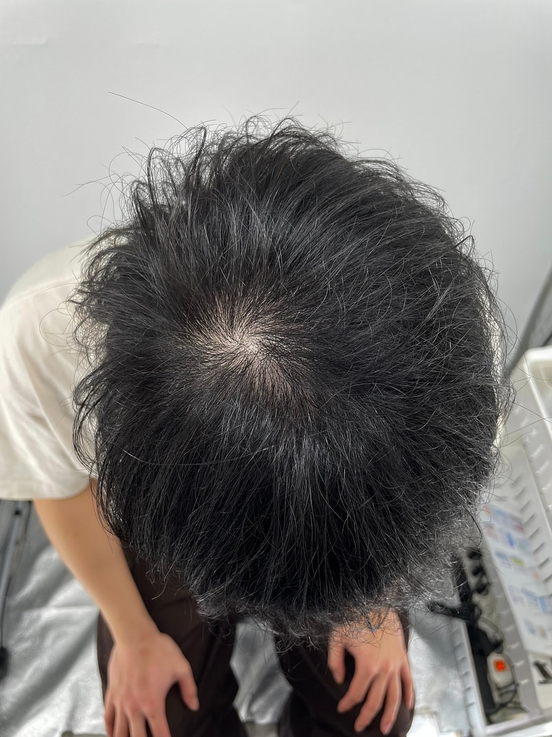 26 year old male head hair loss cover review (new hair scalp tattoo) I'm here in Gangnam for a procedure!