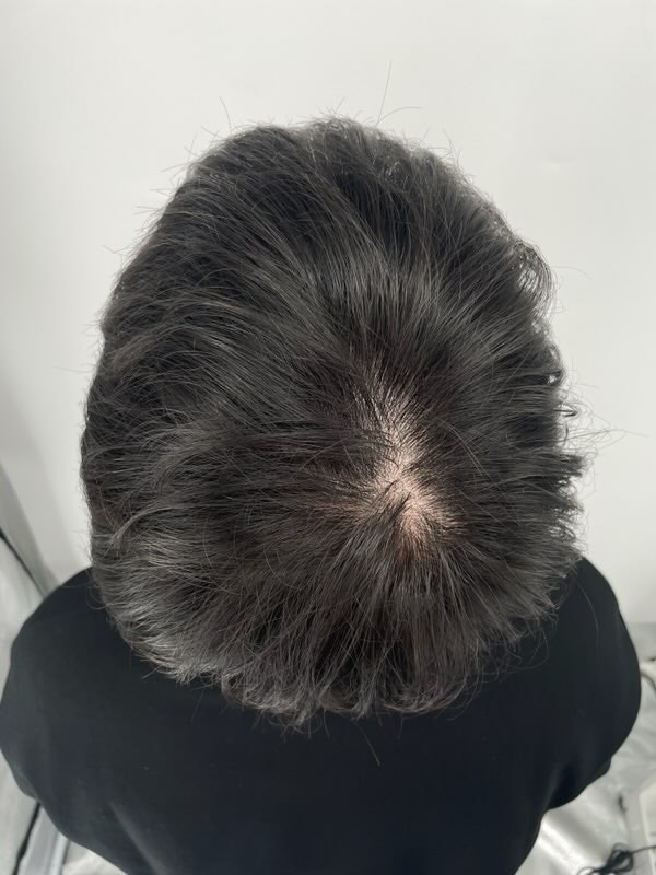 頭皮タトゥー3回目の体験談！！ ニューヘア毛髪整形外科をおすすめする理由！