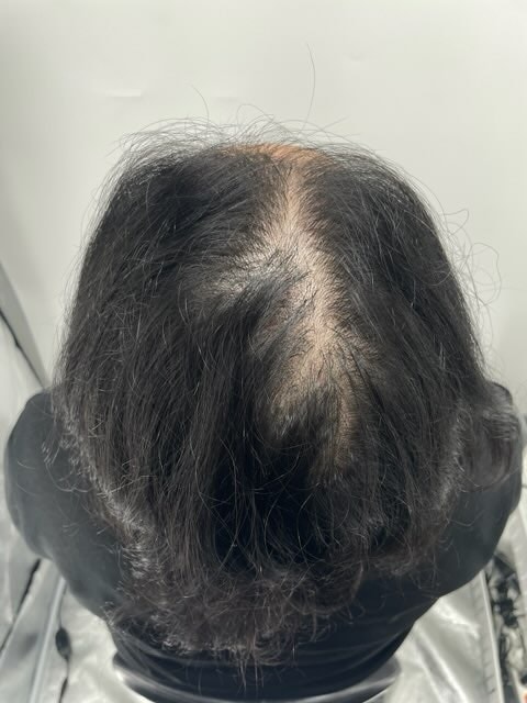 カンナムのニューヘア頭皮タトゥーの最終3回目の施術体験談です。