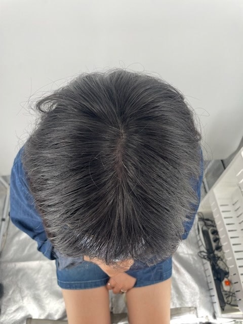 ニューヘア医院2回目の頭皮タトゥー 江南頭皮タトゥー病院 薄毛病院 病院 体験談