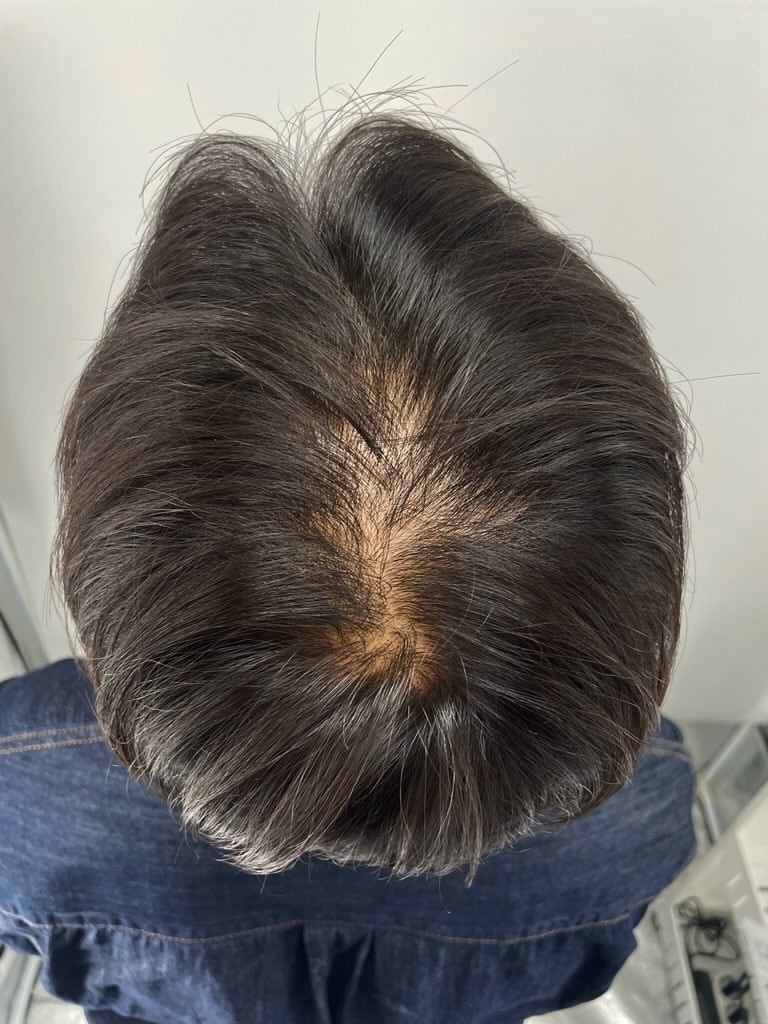 治疗后选择头皮纹身的契机！ 江南NEWHAiR 植发中心
