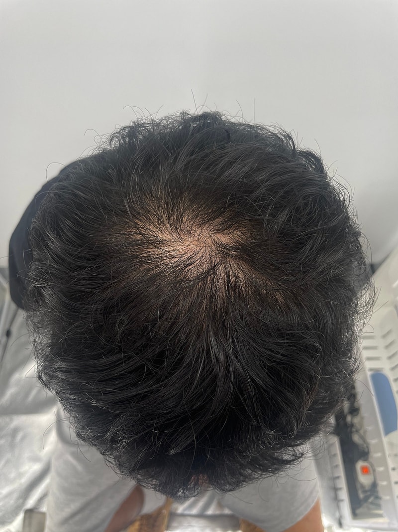 정수리 두피문신 강남 탈모병원 뉴헤어성형외과에서 커버했습니다! 아주 감쪽
