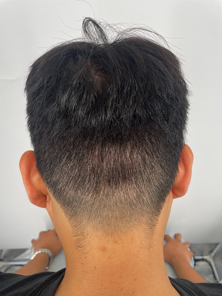 薄毛クリニックで非切開 傷 カバー 頭皮タトゥーを選択したきっかけ（江南ニューヘアー整形外科）