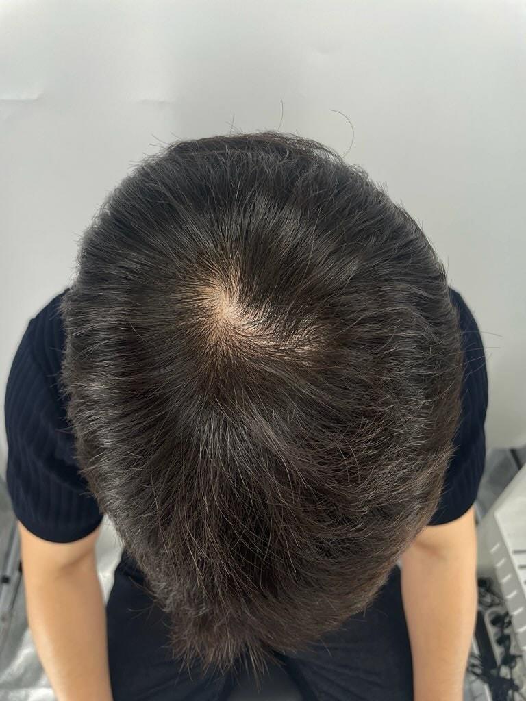 강남 탈모병원 뉴헤어성형외과 두피문신 후기