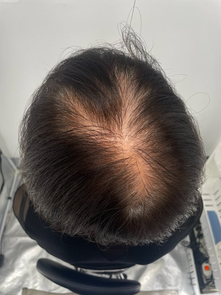 ニューヘアー3回目の頭皮タトゥー体験談です。 江南の頭皮タトゥー一番得意なクリニックで受けました!