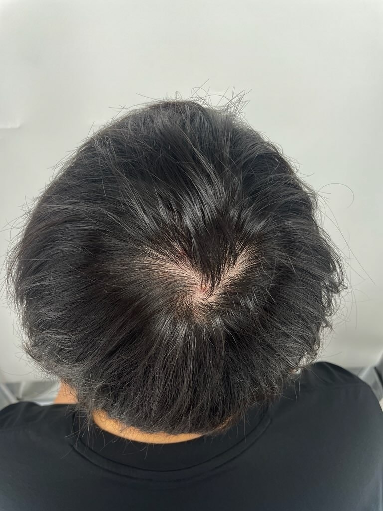 뉴헤어 강남두피문신병원에서 정수리 두피문신 받은 후기^^ 너무 친절하고 꼼꼼하게 잘 해주셔서 만족합니다