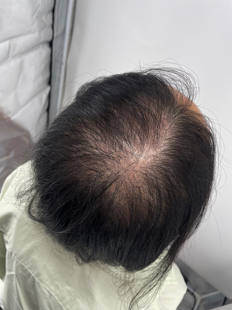 정수리 두피문신 후기 강남 뉴헤어성형외과 아주 잘합니다