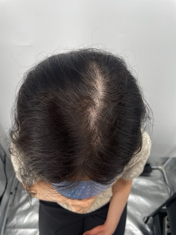 뉴헤어성형외과 두피문신 2차 시술 후 느낀점 강남 탈모병원 두피문신