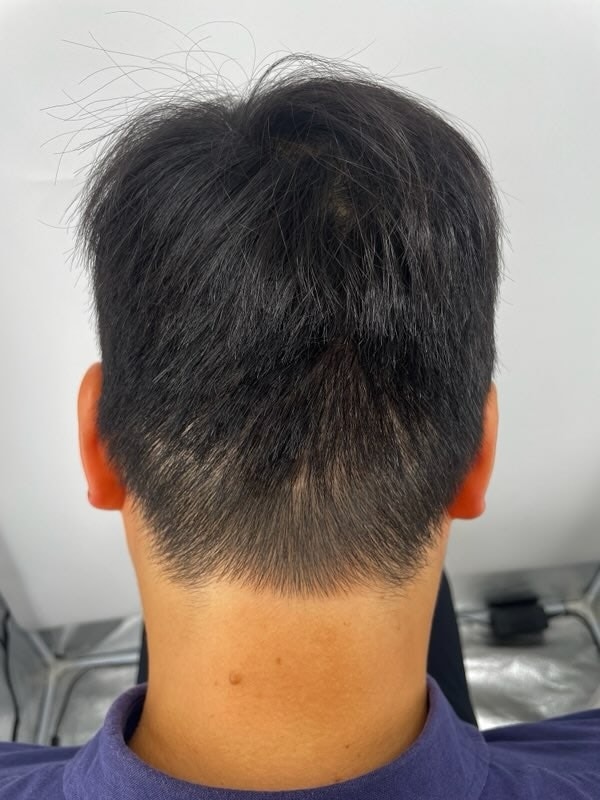 It was uncomfortable because of the Hair Transplant surgery wound, but it got a lot better thanks to the meticulous scalp tattooing at the scalp tattoo hospital.