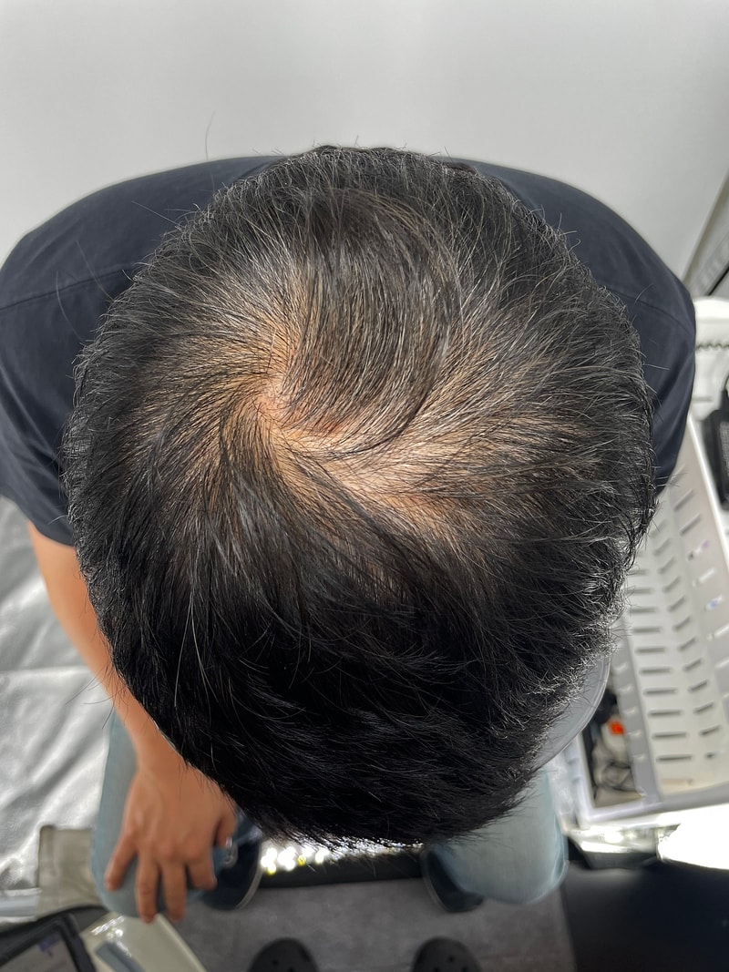 강남두피문신 뉴헤어성형외과 병원에서 받으세요! 정말 돈 값 합니다!