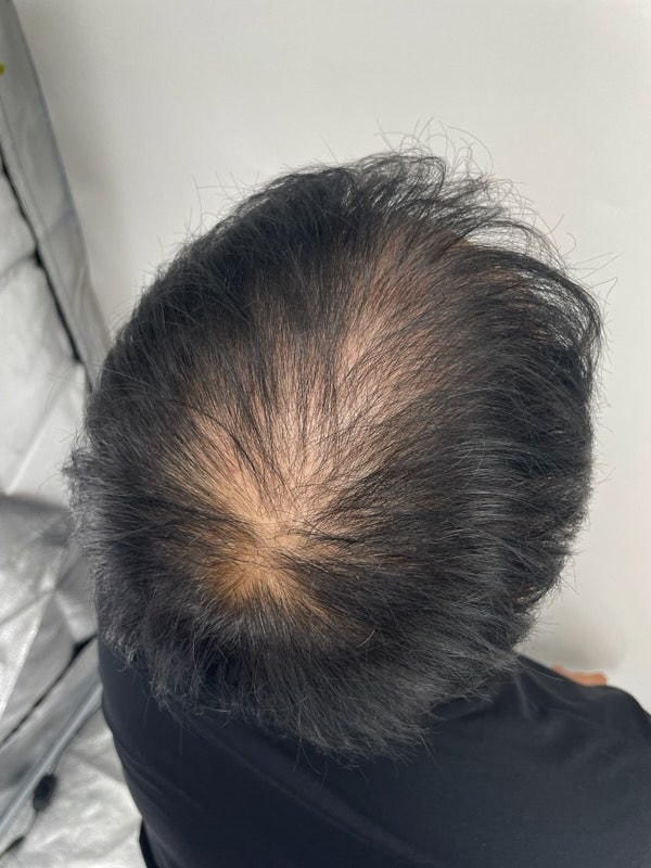 뉴헤어 강남두피문신 맛집입니다! 인정