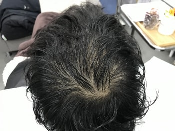 정수리 두피문신 시술전(2)