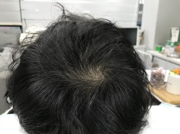 정수리 두피문신 시술전(1)