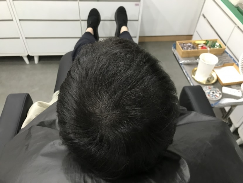 시술후