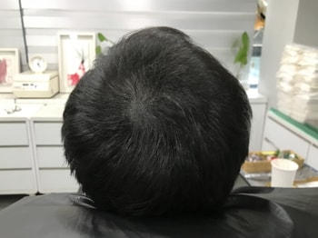 시술후