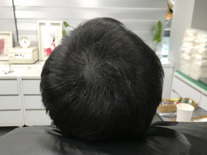 시술후