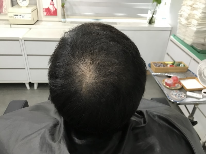연세미다인 정수리 두피문신 후기