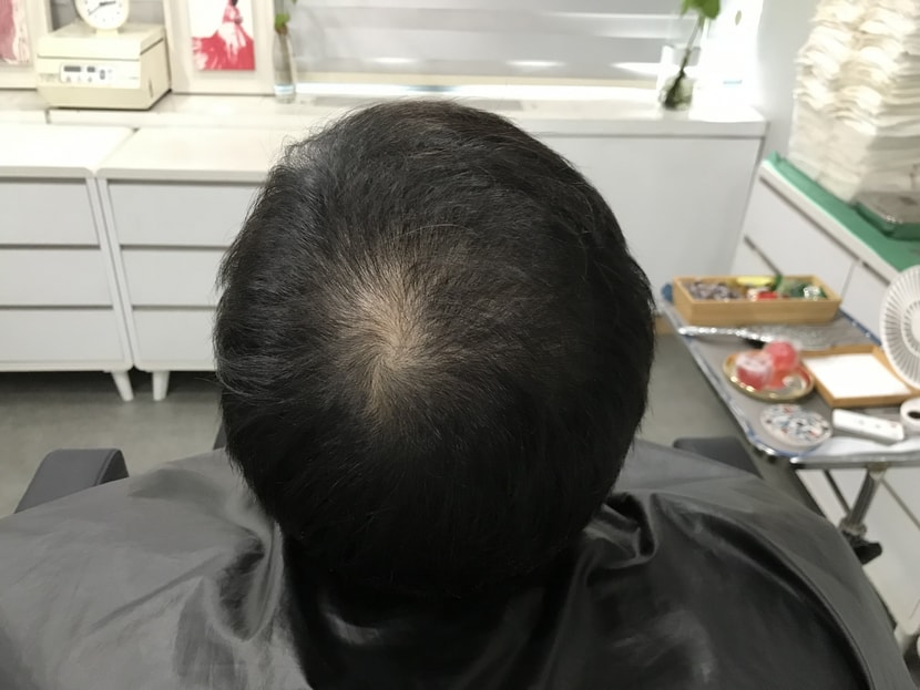 시술전