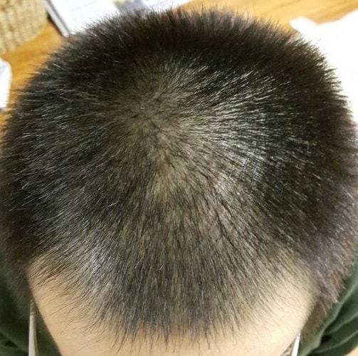 这是头皮纹身后记