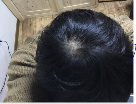 是头顶头皮纹身后记！~