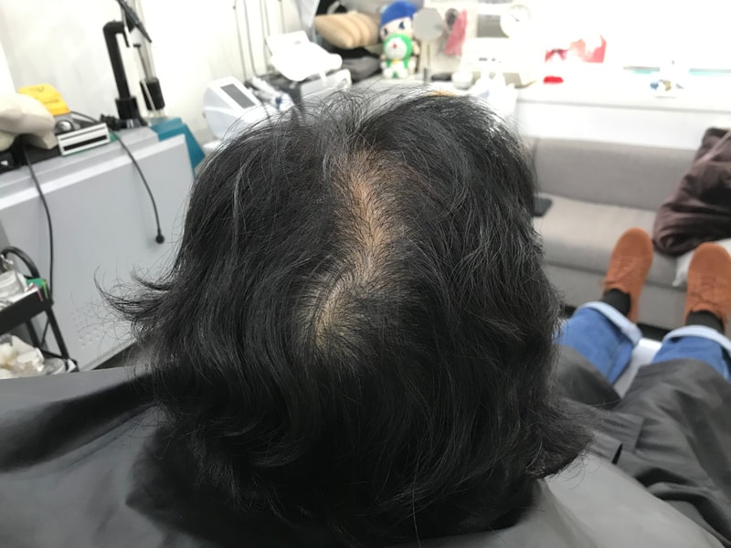 头皮纹身后期
