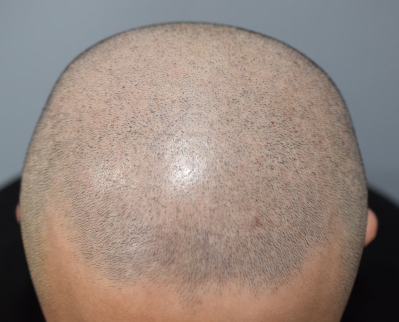 3번의 수술 실패 그리고 두피문신