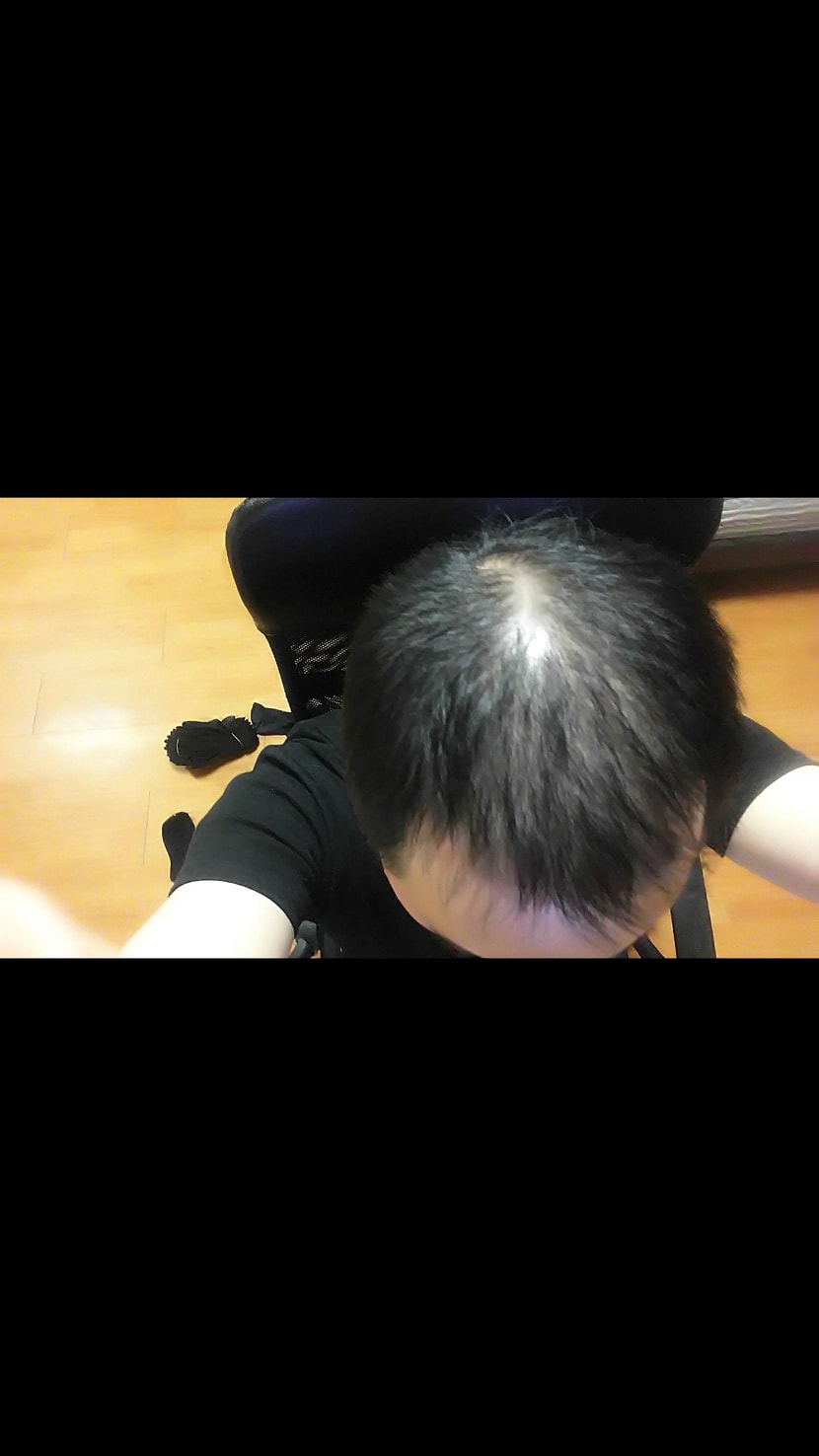 시술후