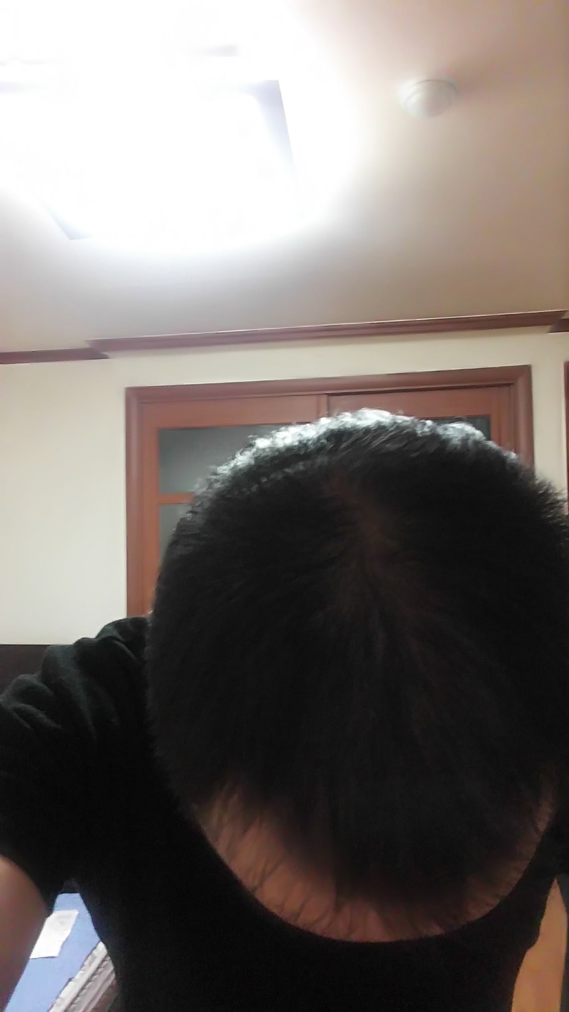 시술후