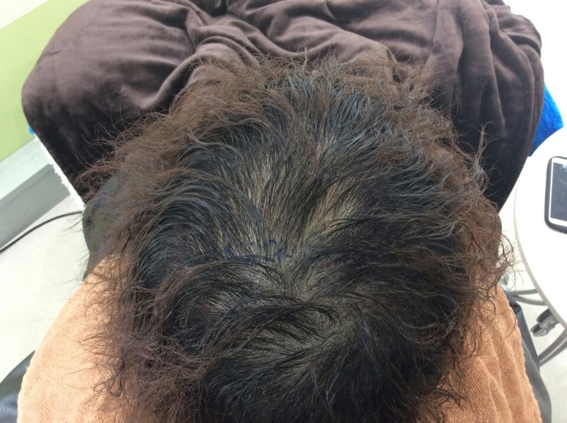 sc遮瑕术后记 请大家参考