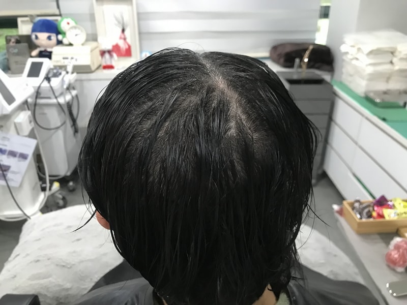 頭頂部の頭皮タトゥー後記