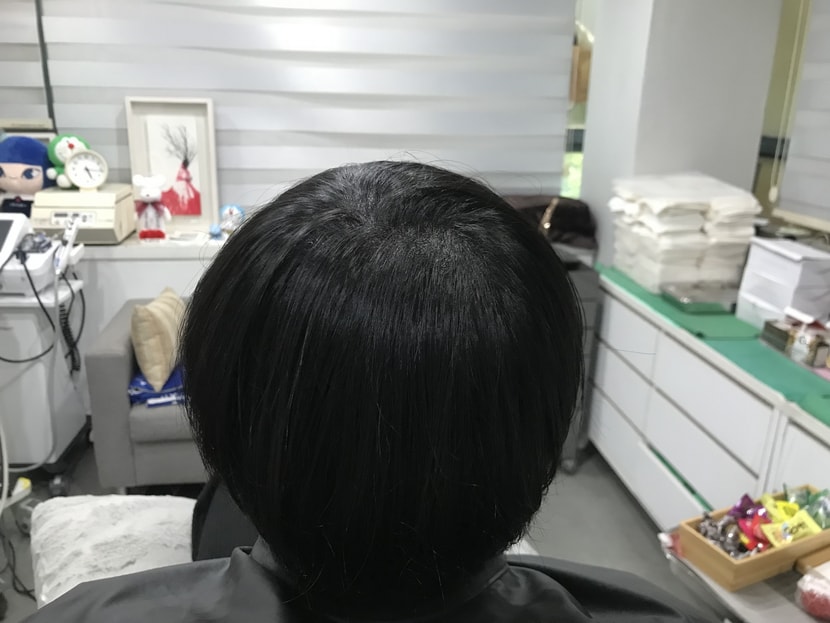 시술 후
