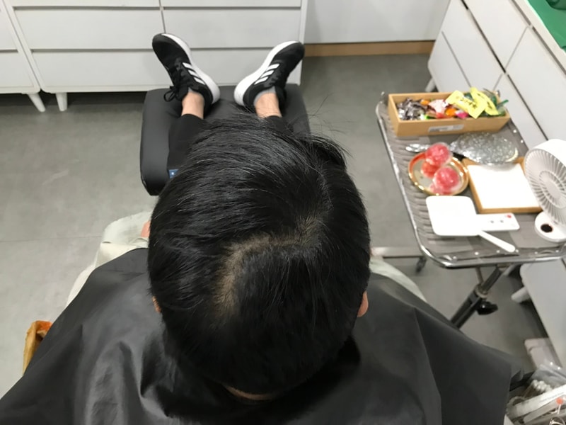 グラデーションドット 頭皮タトゥー 1次体験談