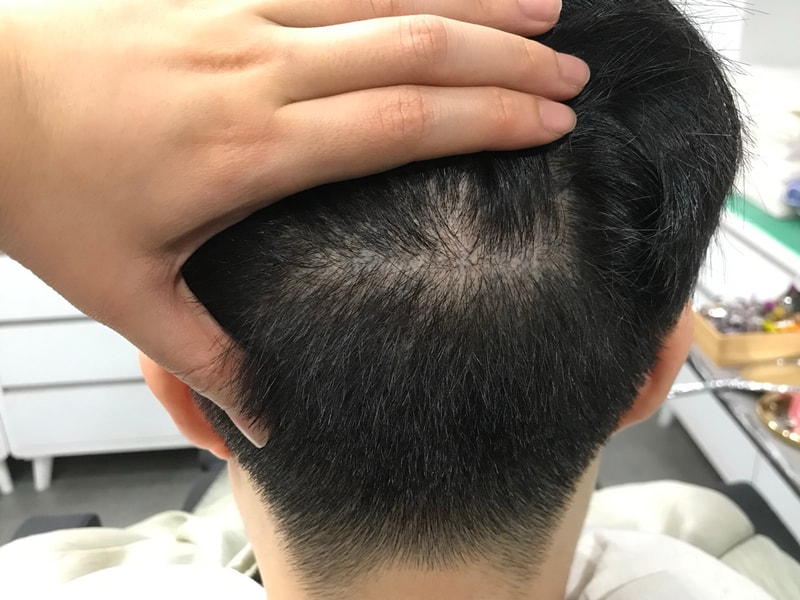 [延世美达人] 头皮纹身后记