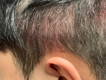귀 옆에 원래 머리가 없던 부분까지 신경써주셔서 시술해주셨어요