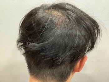 정수리는 모발이식 부분을 제외한 모낭 부족으로 이식하지 못한 곳을 시술로 관리해주셨어요
