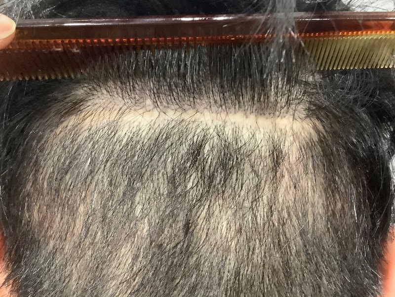 [江南michelan] 毛发移植1个月后 SMP 头皮纹身1次