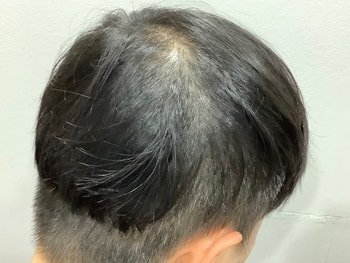 정수리 및 귀 옆 시술 전