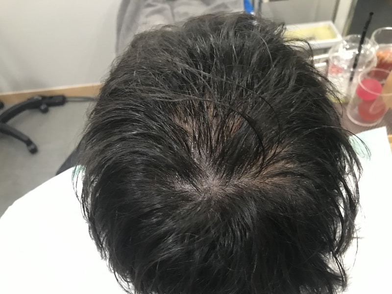 头皮纹身后记（之后）