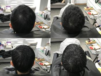 시술 전