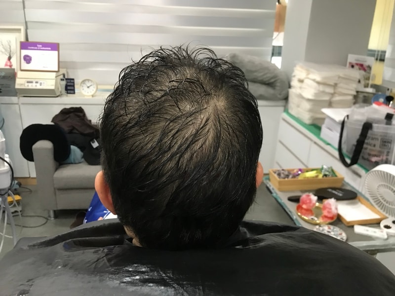 연세미다인 미세그라데이션 도트 시술받은 후기